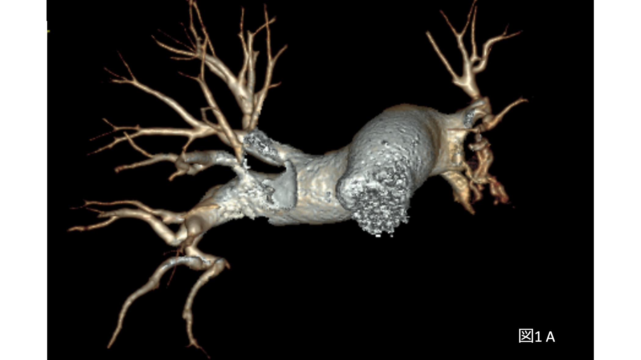 術前検査 造影CTおよび肺血流シンチグラフィ（図1）