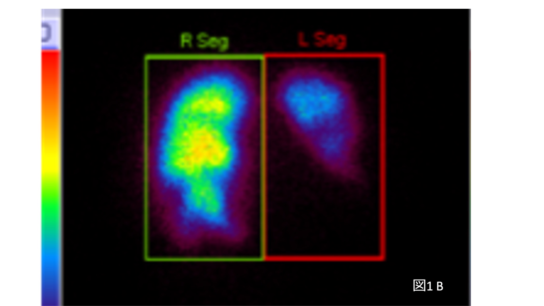 摘出した肺動脈内膜および血栓（図2）