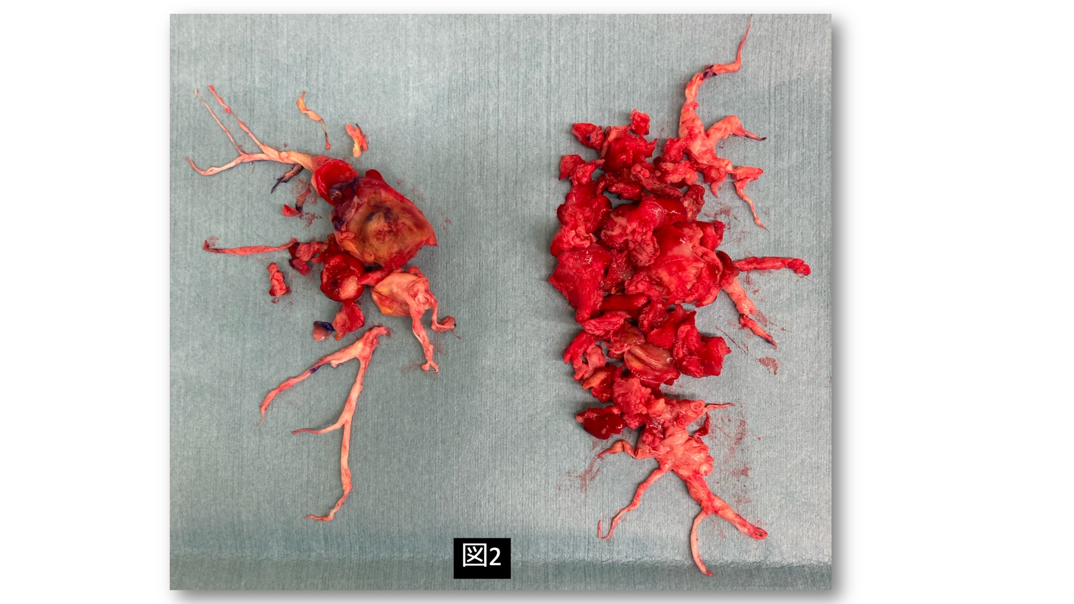 術後造影CT 広範囲の閉塞改善（図3）