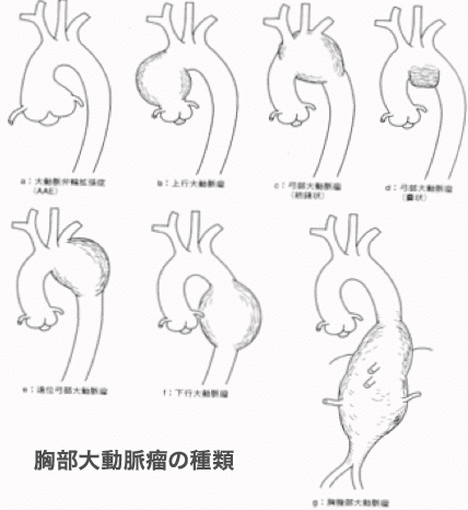 腹部大動脈瘤の種類